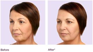 Juvéderm™ results