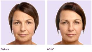 Juvéderm™ results