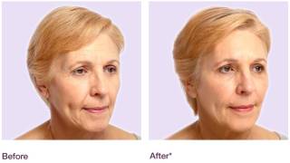 Juvéderm™ results